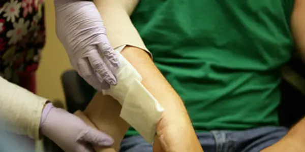 Burn Injuries
